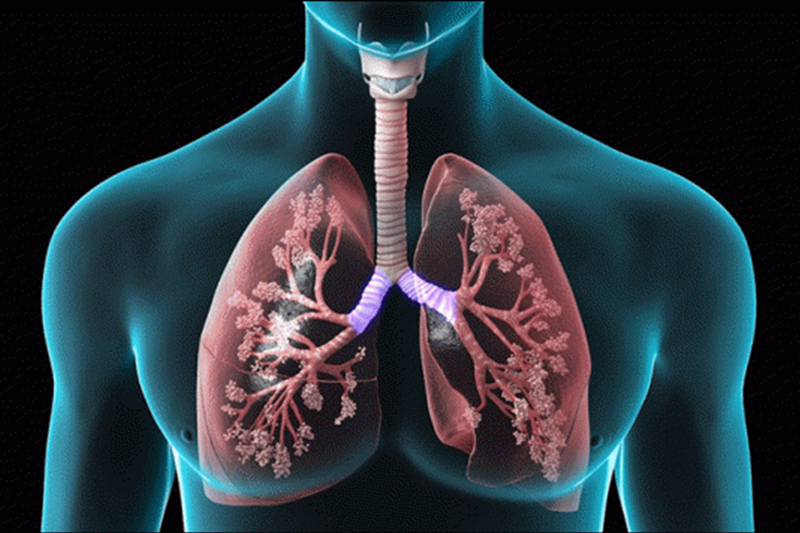 Những nguyên nhân "không tưởng" làm tổn thương phổi